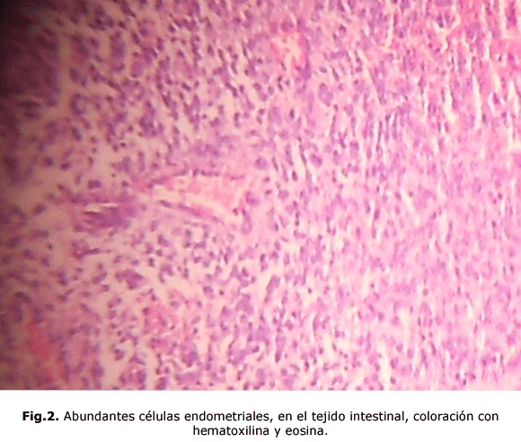 Fig.2. Abundantes células endometriales, en el tejido intestinal, coloración con hematoxilina y eosina.