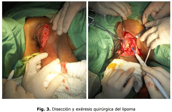 Fig. 3. Disección y exéresis quirúrgica del lipoma