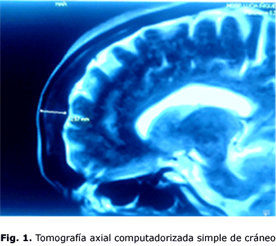 Fig. 1. Tomografía axial computadorizada simple de cráneo