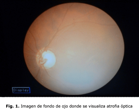 Fig. 1. Imagen de fondo de ojo donde se visualiza atrofia óptica